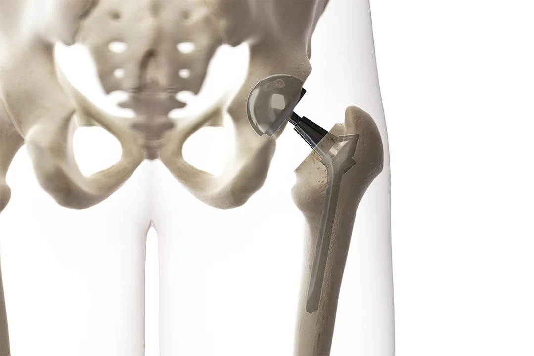 Custom Made Hips - London Sports Orthopaedics