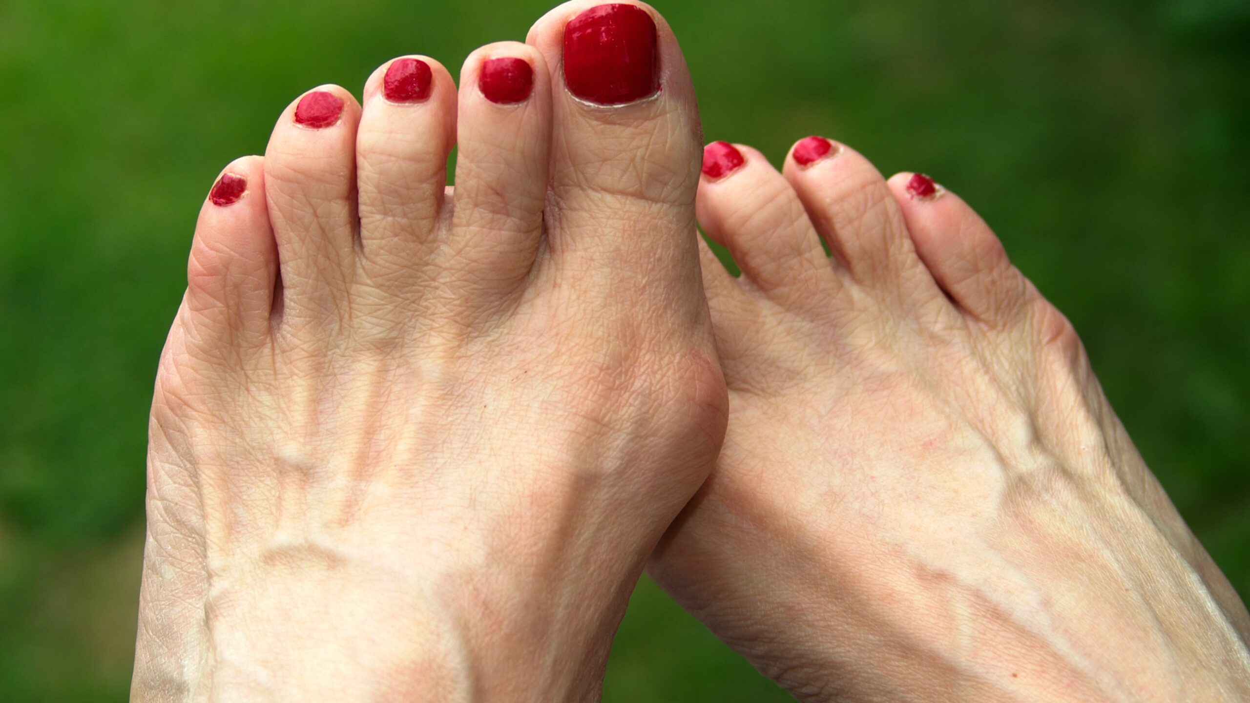 bunion 1